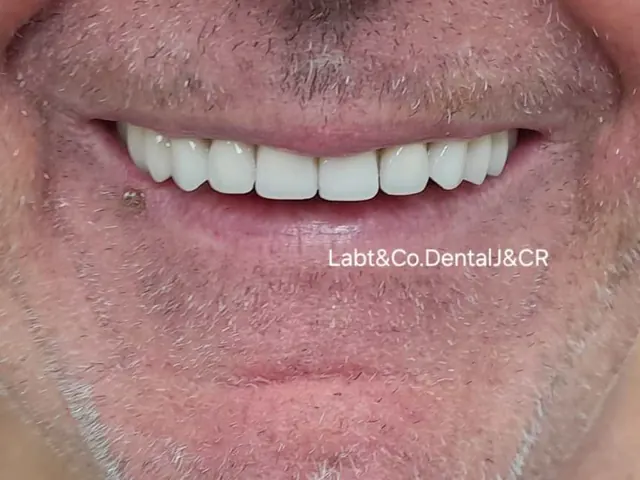 Sonrisa de paciente con prótesis de J&CR