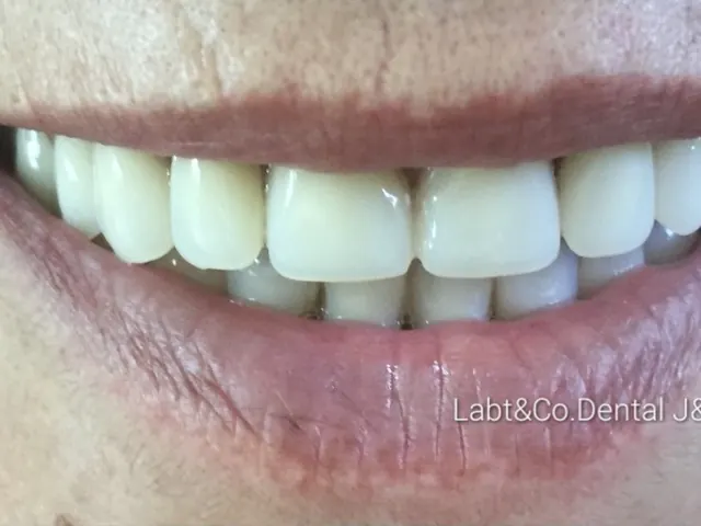 Sonrisa de paciente con prótesis de J&CR