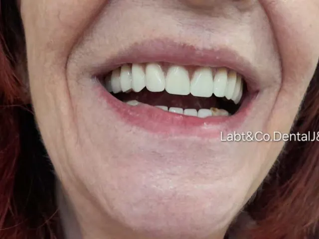 Sonrisa de paciente con prótesis de J&CR