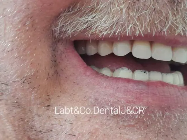 Sonrisa de paciente con prótesis de J&CR
