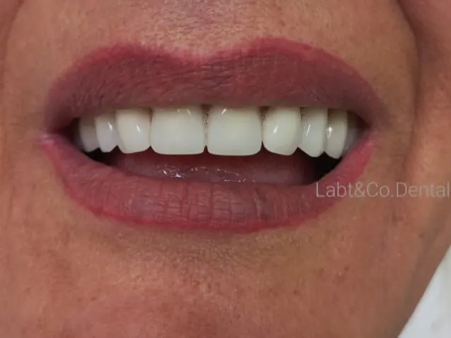 Sonrisa de paciente con prótesis de J&CR