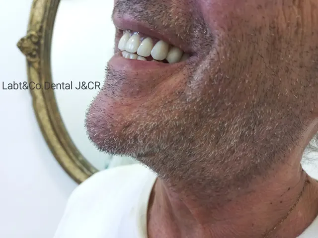 Sonrisa de paciente con prótesis de J&CR