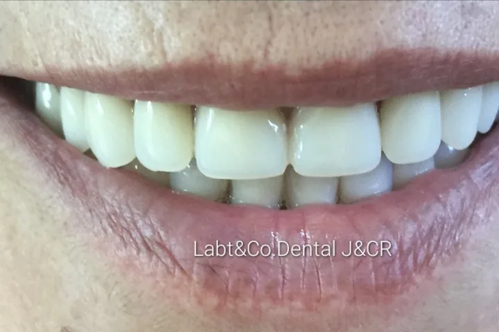 Sonrisa con prótesis hecha en el laboratorio J&CR